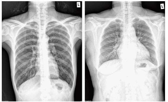 X-Ray Image Contrast Enhancement Based On Tissue Attenuation