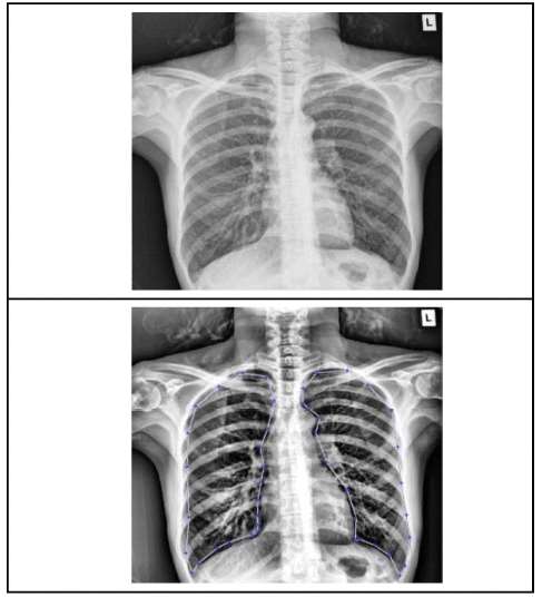 Distinguishing Normal and Pulmonary Edema Chest X-Ray Using Gabor Filter and SVM