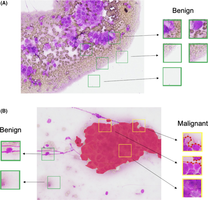Effectiveness of convolutional neural networks in the interpretation of pulmonary cytologic images in endobronchial ultrasound procedures